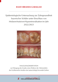 Epidemiologische Untersuchung zur Zahngesundheit bayerischer Schüler unter Einschluss von Molaren-Inzisiven-Hypomineralisation im Jahr 2022/2023